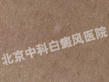 пư