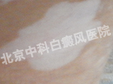 пư
