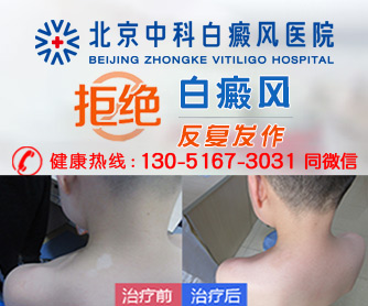白癜风怎么治疗